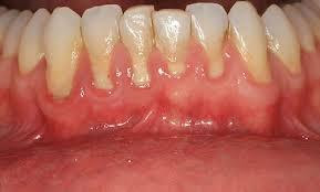 receding gums treatment