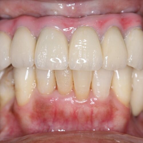Full Mouth Dental Implants: Malo Titanium Bridge with Zirconia Crowns