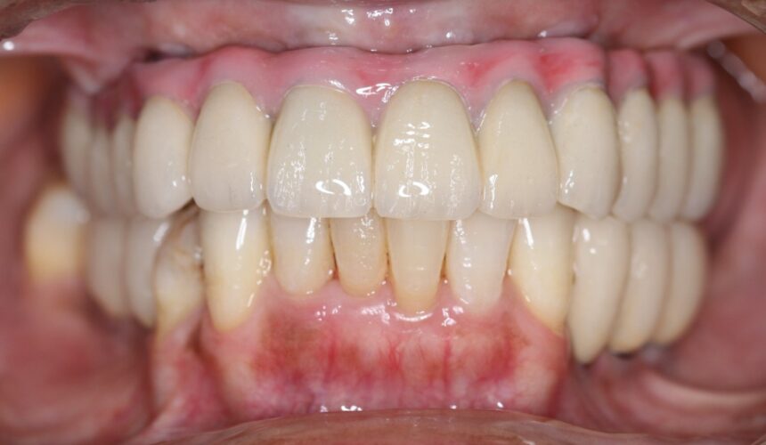Full Mouth Dental Implants: Malo Titanium Bridge with Zirconia Crowns