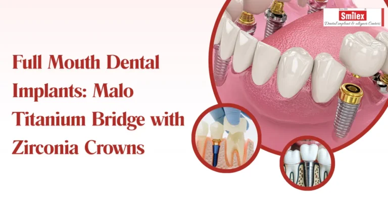 Full Mouth Dental Implants