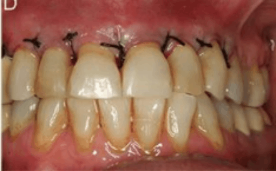 gum flap surgery before and after