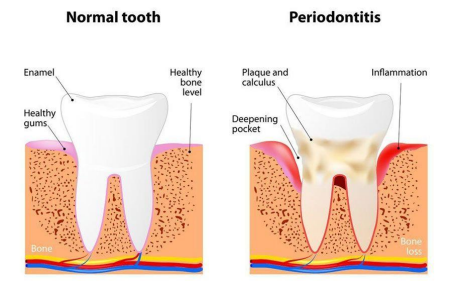 periodontist gum surgery