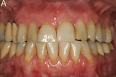 periodontal flap surgery before and after