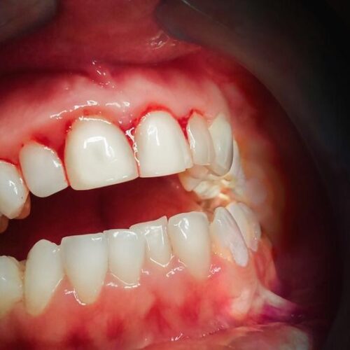 Bleeding gums…..Is it a serious issue? What do they say?