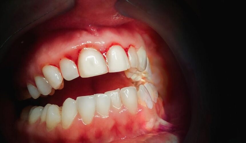 Bleeding gums…..Is it a serious issue? What do they say?
