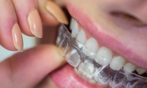 Teeth straightening clear Aligners