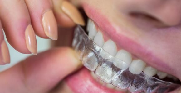 Teeth straightening clear Aligners