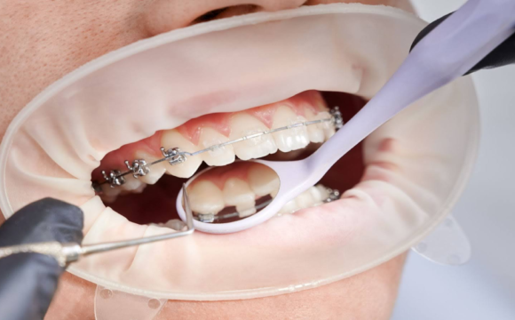 Enhance Your Smile with the Best Orthodontist in Pune