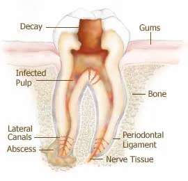 root canal treatment in pune provided by Smilex