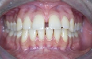  reasons for orthodontic treatment