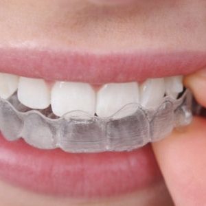 Invisalign Teeth Straightening