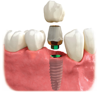 Single Tooth Implants