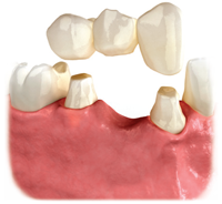 Single Tooth Implants