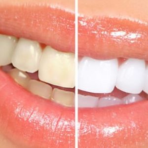 Teeth Whitening Services