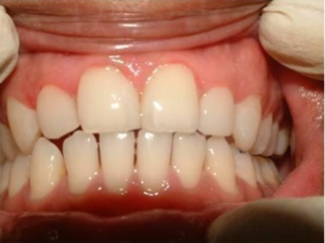 All spaces in between teeth closed by Cosmetic veneers showing pleasant