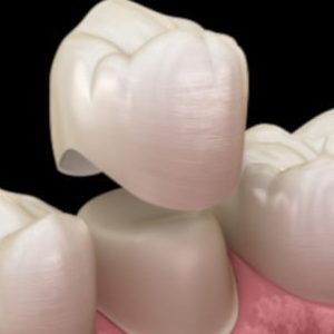 Tooth Crowns And Dental Bridges