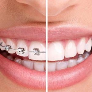 Orthodontic Treatment in Pune