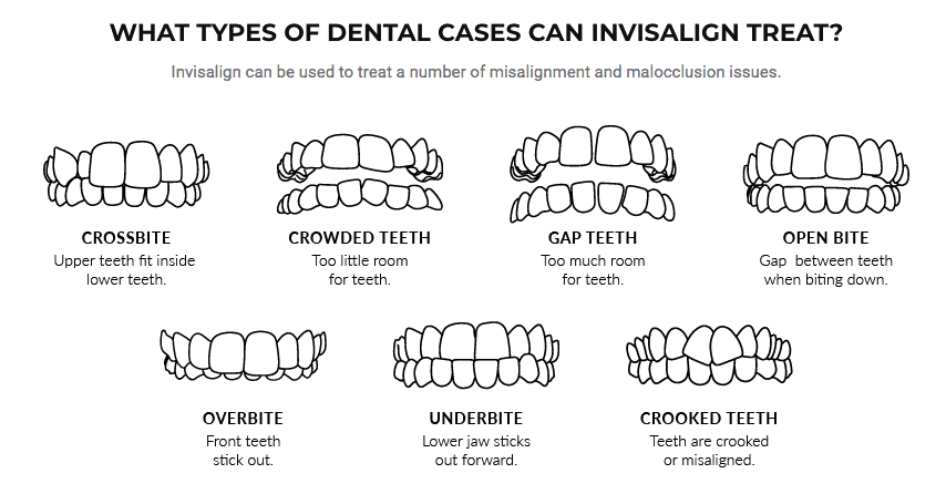 Dental Cases types for Invisalign treatment