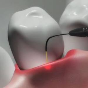 Advanced Laser Dentistry