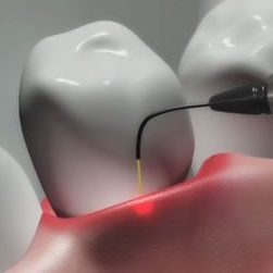 Dental lasers at Smilex