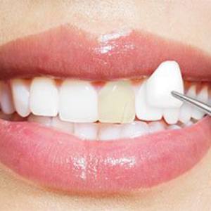 Dental Veneers in Pune