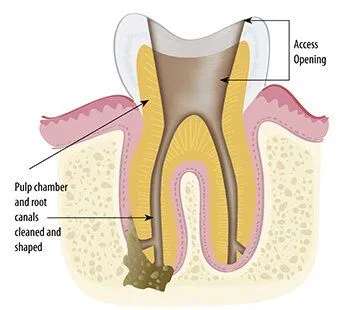 root canal treatment steps