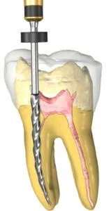 root canal treatment procedure