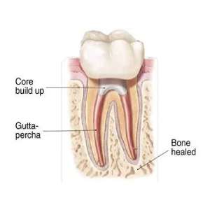 tooth root canal treatment