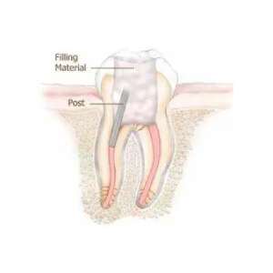 root canal permanent filling