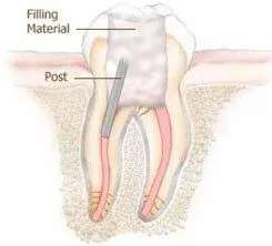 root canal treatment steps with pictures