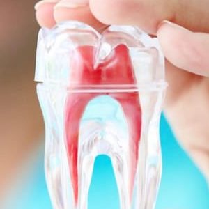 Root Canal Specialist in Pune