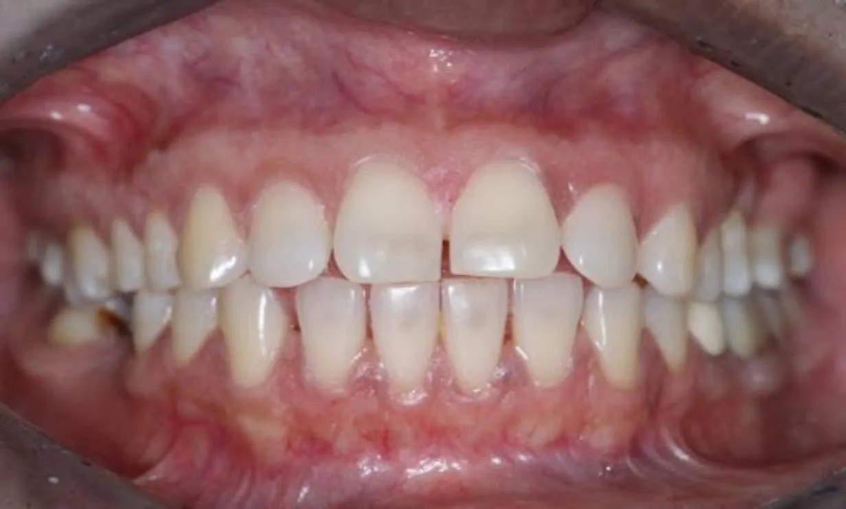 Invisalign dental braces case 1