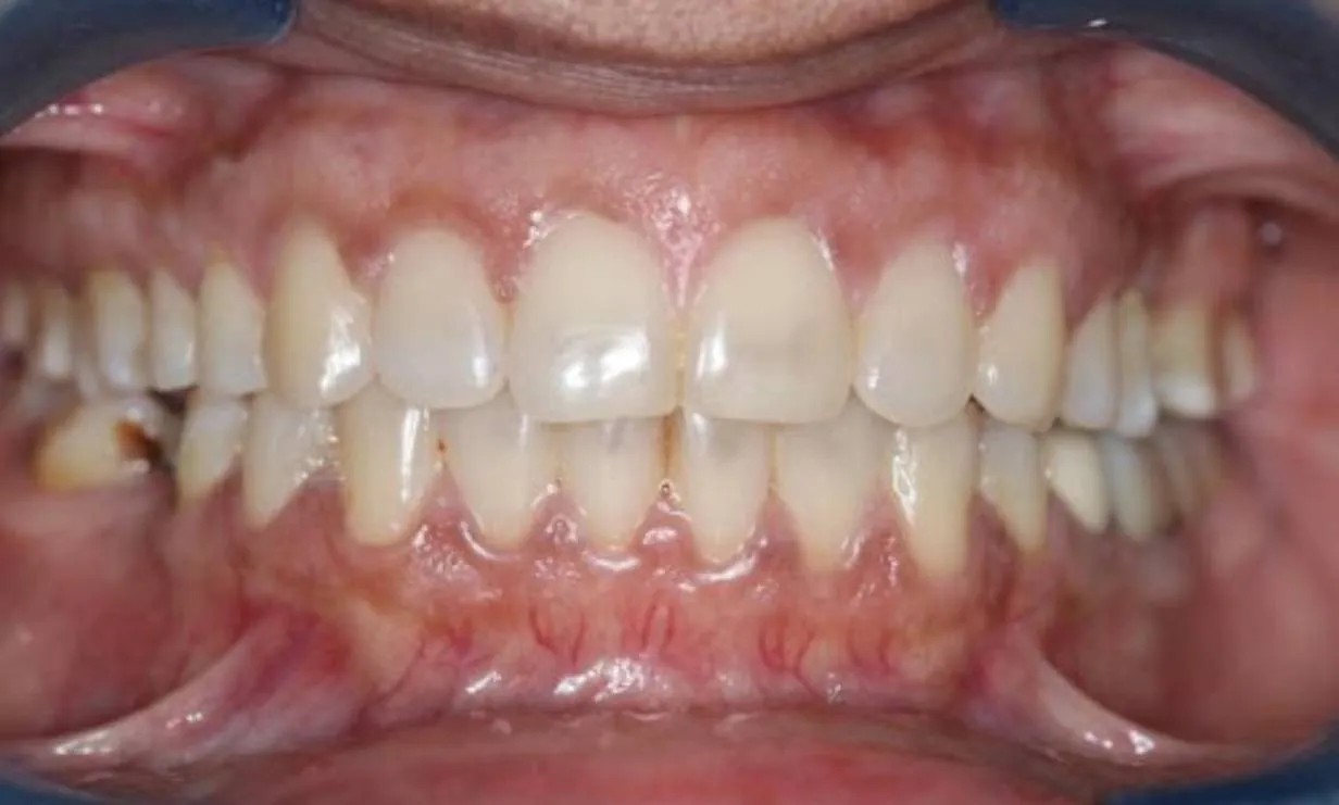 Invisalign dental braces case 1