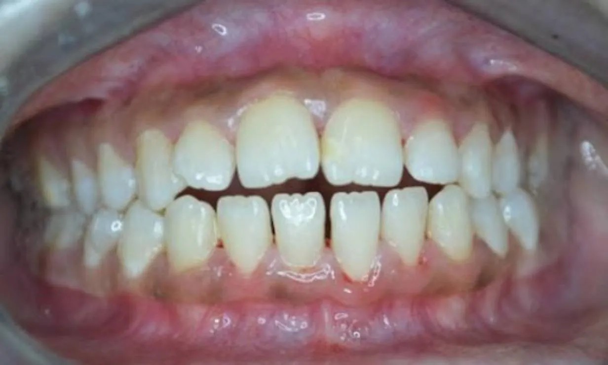 invisalign treatments Case 3