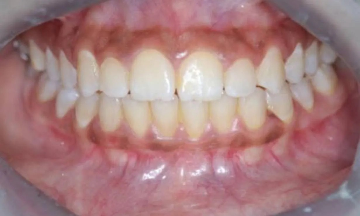 invisalign treatments Case 3