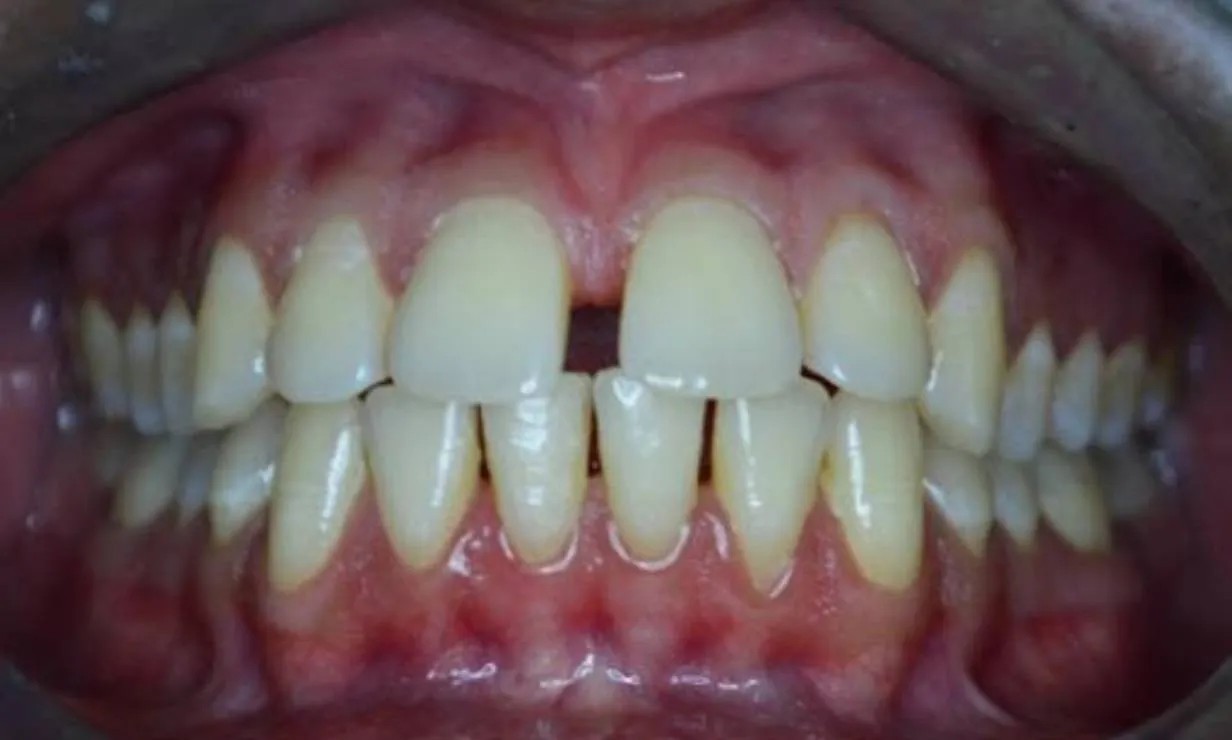 invisalign aligner braces case 4