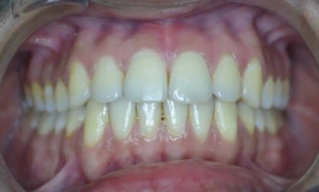 invisalign aligner braces case 4