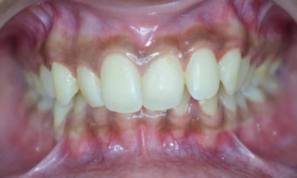 invisalign aligner braces dental clinic case 5