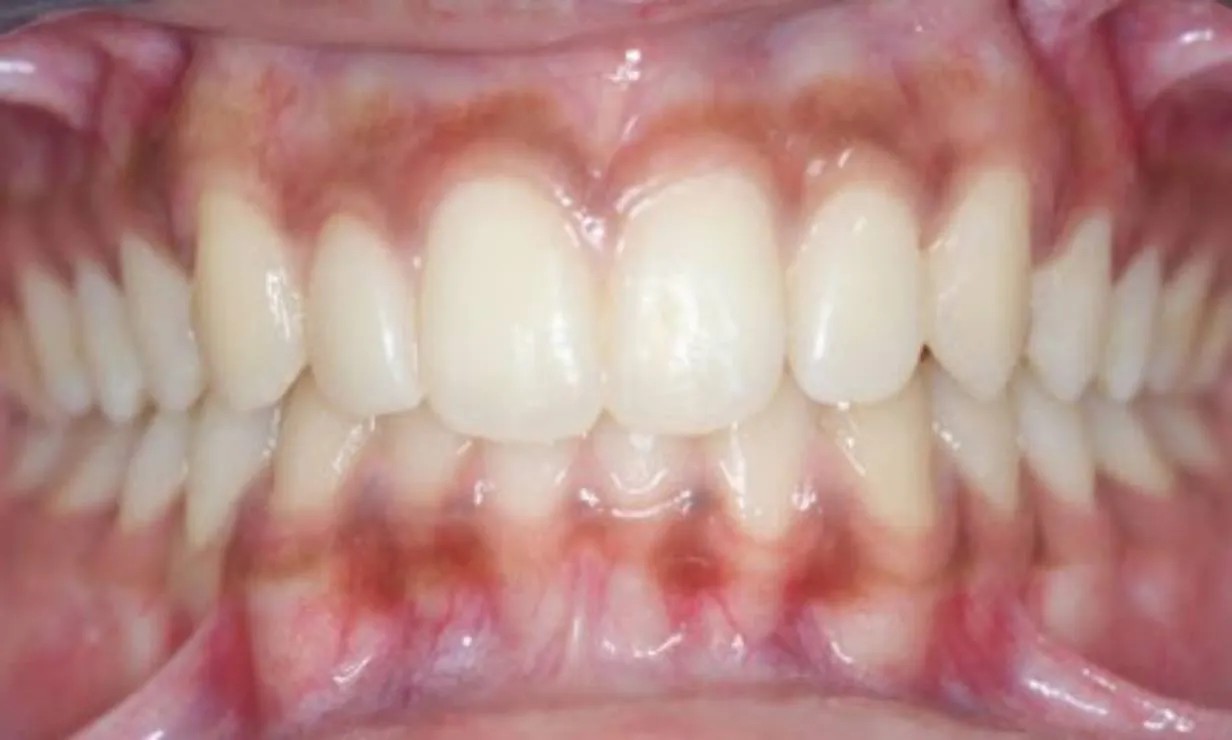 invisalign aligner braces dental clinic case 5