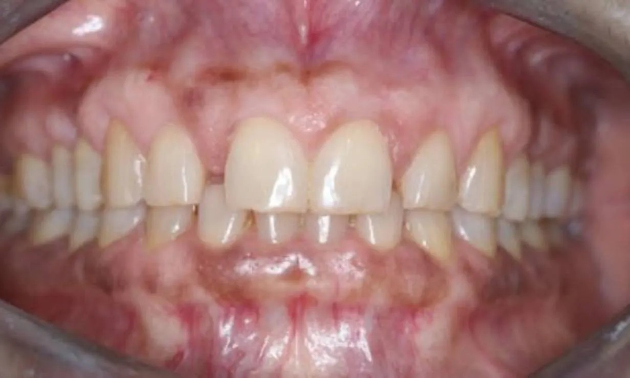 invisalign dental treatment case 6