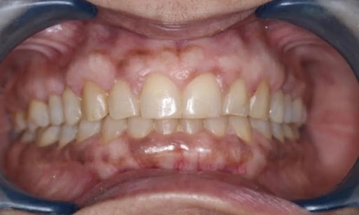 invisalign dental treatment case 6