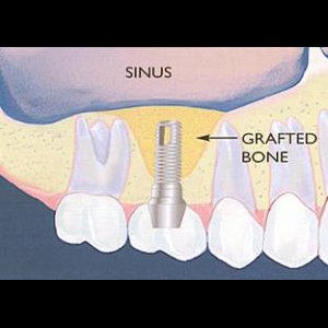 Sinus Grafting