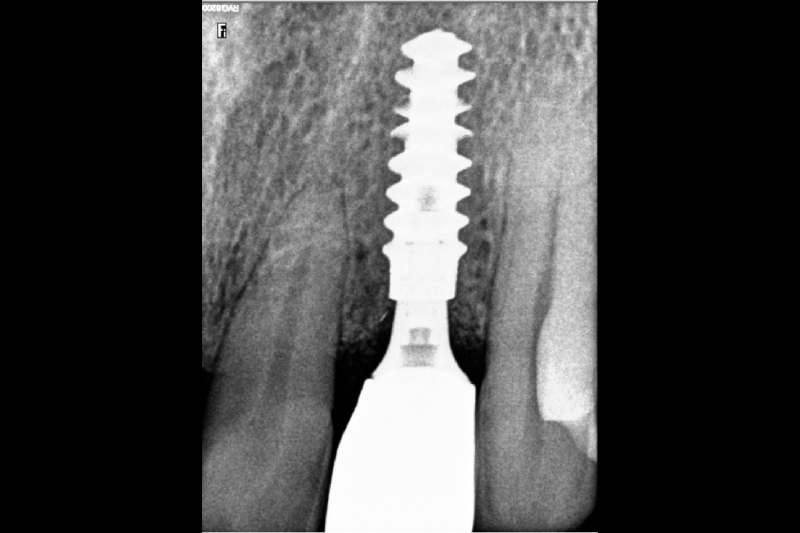 neodent implant price