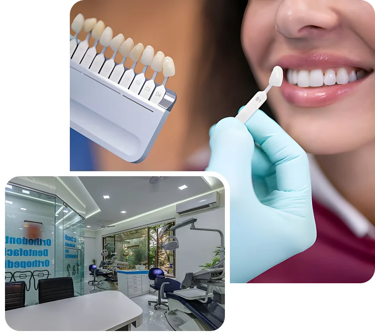 Teeth Whitening