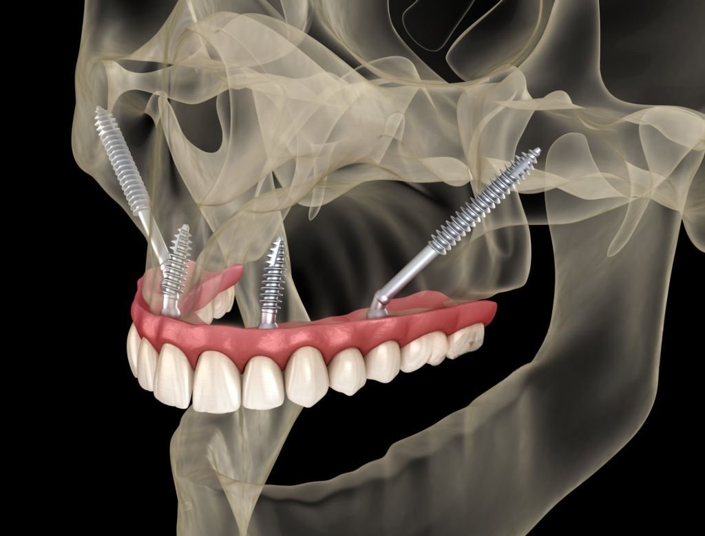 Zygomatic All-on-4
