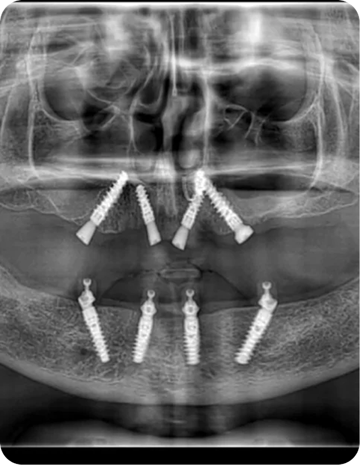 All-on-4 Implants