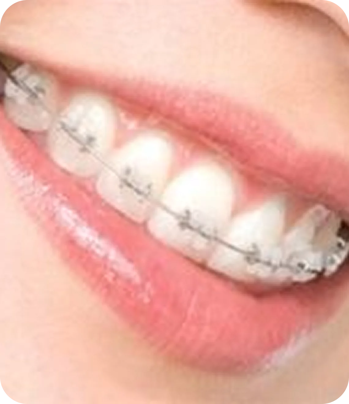 Ceramic Braces
