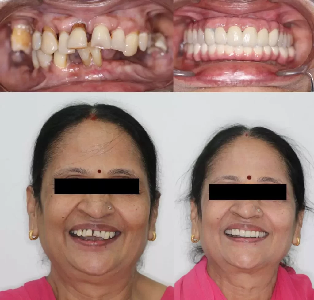 Full Mouth Rehabilitation