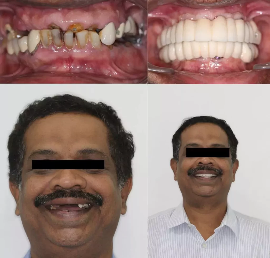 Dental Implants
