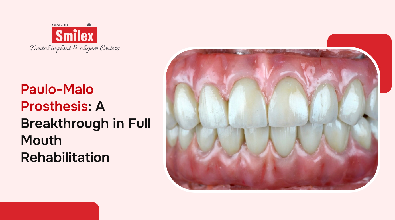 Paulo-Malo Prosthesis: A Breakthrough in Full Mouth Rehabilitation
